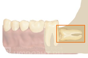 Описание: Ретенированный (не прорезавшийся) зуб мудрости. встречается при нехватке места в зубной дуге.  наиболее сложный случай т.к. зуб  находиться в ветви нижней челюсти